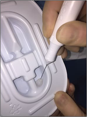 Figure 3. Transvitreal cutter biopsy specimen. Active backflush ejects the biopsy sample from the cutter tip into a receptacle for retrieval. Dark dots are pieces of tumor.