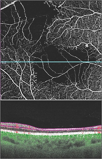Figure 6. Swept-source optical coherence tomography angiography (Plex Elite 9000; Carl Zeiss Meditec) superficial retina slab of 12 mm x 12 mm scans showing nonperfusion corresponding to DRIL seen on the optical coherence tomography B-scan.