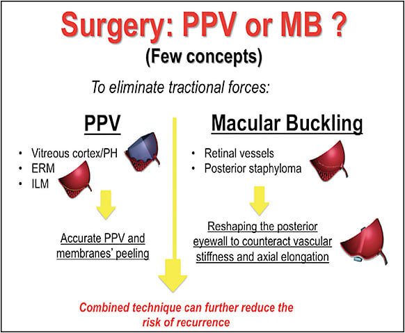 Figure 4. Retinal tractions that can be reduced by PPV or MB in HM eyes.