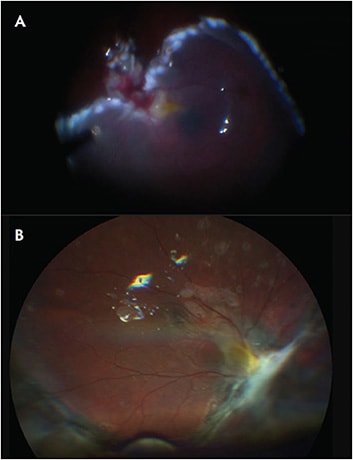 Figure 6. A patient presented with a metallic intraocular foreign body with a posterior impact site adjacent to the optic nerve inferonasally. An intraoperative image (A) shows that there was still contraction along the inferior edge of the retinectomy under perfluorocarbon liquid but due to the proximity to the optic nerve and macula, the decision was made not to remove additional retina posteriorly. Postoperatively, the patient had significant fibrosis along this edge, but the retina remained attached under oil (B). Images courtesy of Durga Borkar, MD.