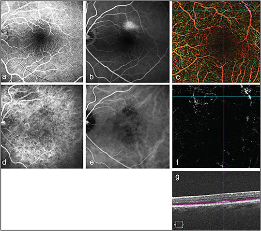 Figure 1. Fluorescein angiography, ICG, and OCTA (Zeiss Angioplex) of a patient with a known history of dry AMD. Early FA without evidence of pathology or vascular abnormalities (A). Late staining / leakage seen in the superior macula concerning for possible CNV (B). Depth-encoded retinal OCTA (6 mm x 6 mm) demonstrates no obvious retinal vascular abnormalities (C). Early ICG demonstrates patchy choroidal filling (D), while late ICG (E) demonstrates macular flow voids without any hyperfluorescence or vascular leakage. En-face OCTA through the outer retina (segmentation demonstrated in image G) shows no evidence of CNV/vascular structures in area corresponding to area of late hyperfluorescence seen on FA (F, G). In this case, the lack of nonspecific background staining allows OCTA to clearly demonstrate the lack of CNV, whereas FA is ambiguous. Use of OCTA in this case may obviate the need for further invasive dye testing to monitor this patient.
