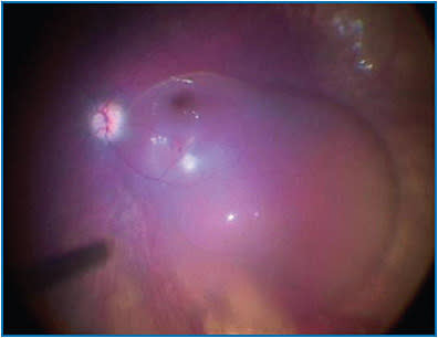 Figure 3. Subretinal bleb in patient’s right eye following injection of 0.3 mL of voretigene neparvovec-rzyl (1.5 x 1011 vg).
Couresty of Aaron Nagiel, MD, PhD, University of Southern California
