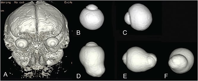 Figure 4. 3D MRI images of the globe. A. 3D images are created by volume rendering based on T2-weighed image of MRI. Then, the images of the eye are extracted. B and C. 3D MRI images of an emmetropic eye. The emmetropic eye is spherical and symmetric in the images viewed from the inferior (B) and nasal (C) positions. D through F. 3D images of the eye with pathologic myopia and posterior staphyloma. Outpouching of the posterior segment, suggesting staphyloma is observed in the images viewed from inferior (D), nasal (E), and back positions. (F).