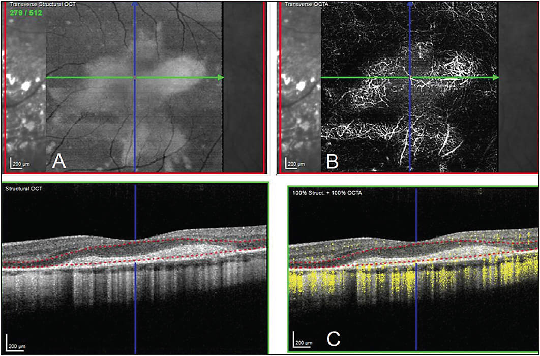 Figure 3. OCTA demonstrating projection artifact. In image B, the OCTA en face image is suggestive of a large type 2 CNVM. However, the OCTA B scan in image C shows lack of yellow signal, which is indicative the absence of flow within the concerning membrane that is being segmented between the red dotted lines. Furthermore, comparison of the image A to image B in the upper right shows similarities with the superficial retinal vasculature, thus confirming projection artifact.