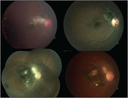 Figure 2. Two cases of acute toxoplasmosis retinitis (top and bottom). Intravitreal clindamycin and dexamethasone administered with resolution of retinitis (bottom). FIGURE REPRINTED WITH PERMISSION FROM ELSEVIER.1