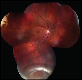 Figure 1. Dislocated intraocular lens.