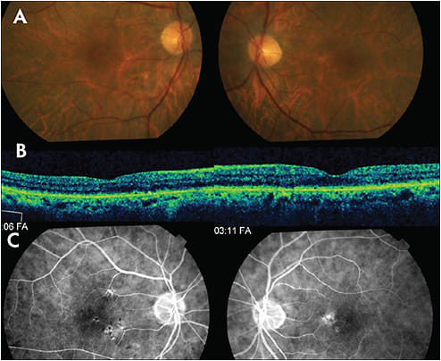 Figure 6. This 71-year-old male was referred with nyctalopia and with subacute blurring of central vision bilaterally. VA measured 20/50 RE and 20/40 LE and fundus examination revealed parafoveal RPE mottling (Figure A). Macular OCT identified a generalized irregularity of the ellipsoid zone (Figure B). FA revealed staining of the RPE mottling only (Figure C). ERG was consistent with rod > cone dysfunction.