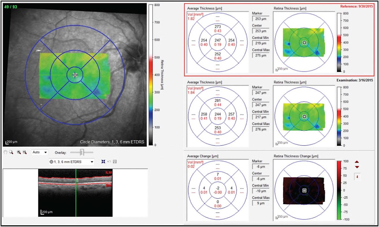 Figure 2. At 1 month post Iluvien implantation OD, central retinal thickness decreased
from 343 µm to 257 µm and VA improved from 20/40 to 20/32.