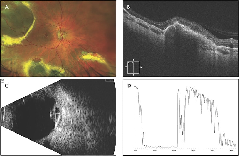 Figure 1. Fundus photograph of the right eye shows peripheral exudative hemorrhagic chorioretinopathy in different stages of development. Depicted are a large temporal lesion with surrounding exudation, 2 inferior lesions with surrounding heme and exudate, and a late-stage inferonasal lesion with a crystalline appearance. Fine macular drusen can also be appreciated (A). Optical coherence tomography of the right eye through the inferonasal lesion reveals a large hemorrhagic pigment epithelial detachment (B). B-scan of the peripheral temporal lesion shows a thickened, dome-shaped membrane with moderately dense submembrane opacities and a plaque-like area of high reflectivity beneath the elevated membranes. No choroidal excavation or orbital shadowing is present (C). A-scan of the peripheral temporal lesion shows low internal reflectivity (D).