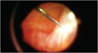 Figure 5. Flattening this large PVR detachment required diathermy, use of perfluorocarbon liquid, and membrane peeling.