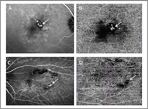 Figure 3. Late-phase indocyanine green angiography (ICGA) showing branching vascular network (BVN) and polyps (white arrows) in eyes with polypoidal choroidal vasculopathy (PCV) (A, C). Optical coherence tomography angiography images (Triton; Topcon) show presence of BVN, which is better delineated in ICGA (B, D). Image B shows presence of polyps in the choriocapillaris slab corresponding to ICGA while image D shows hypointense area with no polyps.