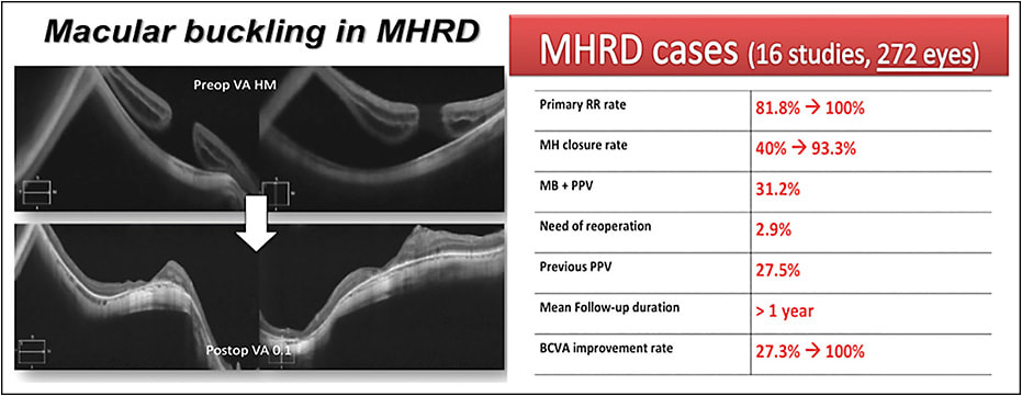 Figure 1. MB in MHRD: OCT scans of an MHRD treated with MB (left). Anatomical and functional results included in the review, as cited in the text (right).