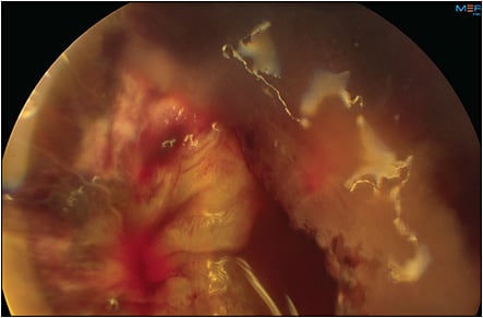 Figure 2. Poor surgical outcome due to intractable intraoperative bleeding in a diabetic patient with hypertension, end-stage renal disease, and warfarin use.