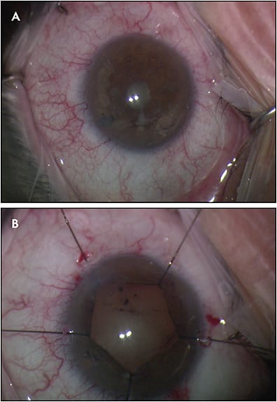 Figure 4.  Intraoperative image of cataract, pupillary membrane, and extensive posterior synechiae, left eye (A). Same eye following synechiolysis, peeling of pupillary membrane, and pupil stretching with iris hooks (B).