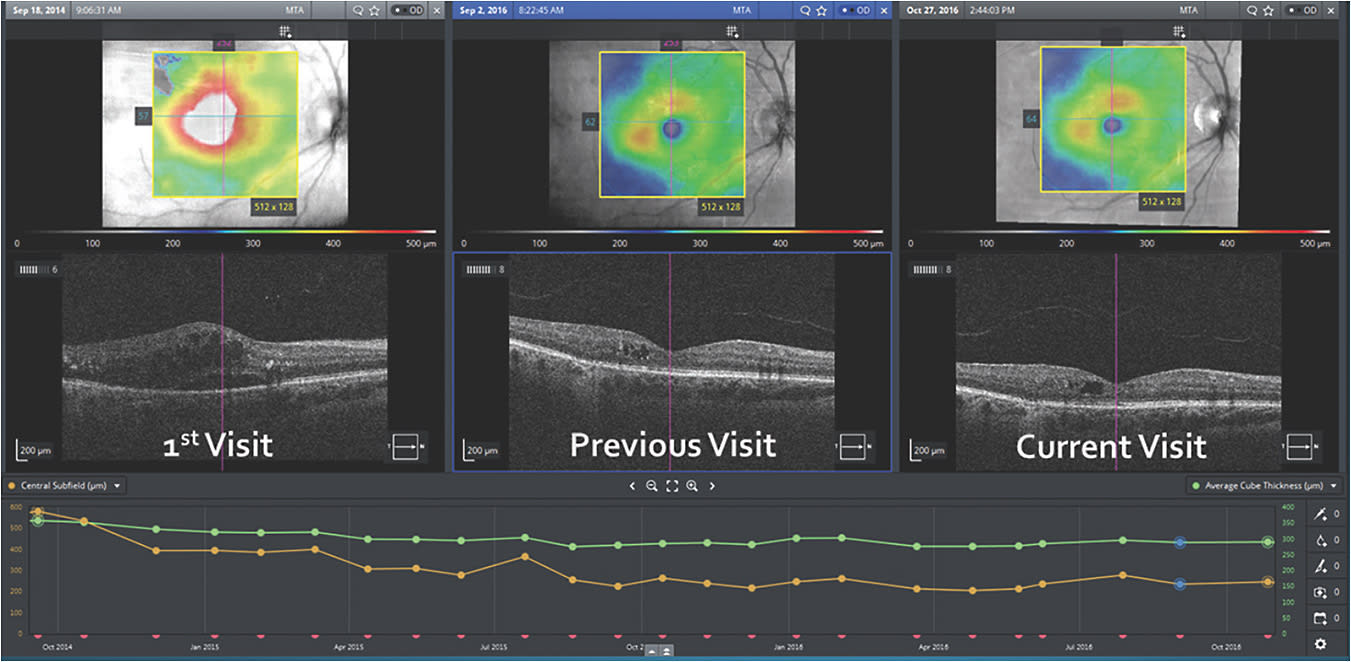 Figure 1. Retina Workspace software from Zeiss allows viewing and manipulation of three sets of OCT scans at once, from any three different dates. In addition, a variety of measures (such as central subfield thickness and average cube thickness, as shown here) can be automatically plotted over time to reveal trends and insights.