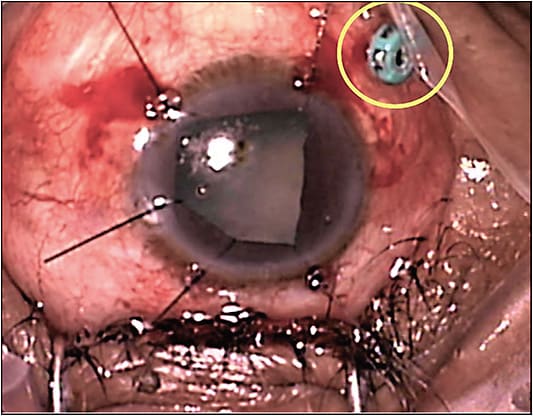 Figure 4. A patient with dense cataract and rhegmatogenous retinal detachment. The infusion line valved cannula (circled) has been placed prior to starting the cataract extraction. This placement prevents globe collapse and iris prolapse, which can occur with trocar placement in the presence of corneal wounds.