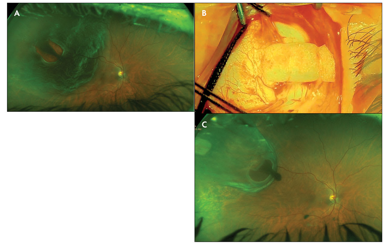 <p><strong>Figure 2. </strong>Preoperative Optos image of right eye of a 61-year-old female who presented with visual acuity 20/400 and rhegmatogenous retinal detachment (A). Intraoperative image of radial sponge placement (B). Two weeks after radial buckle and cryotherapy scleral buckle surgery, visual acuity in the right eye has improved to 20/30 (C).</p>