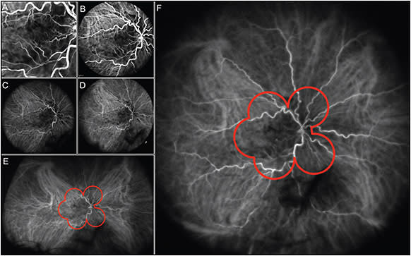 Figure 4. Indocyanine green angiography in a patient with retinal vein occlusion: 30° (A), 55° (B), 60° with Ocular Lee-Mainster SLO Lens (C), 102° noncontact lens (D), and with 150° of the Ocular Staurenghi contact lens (F). Optos imaging system shows 120° on horizontal axis and 80° on vertical axis without the need for a contact lens (E). The red outline shows the 7-standard field view.