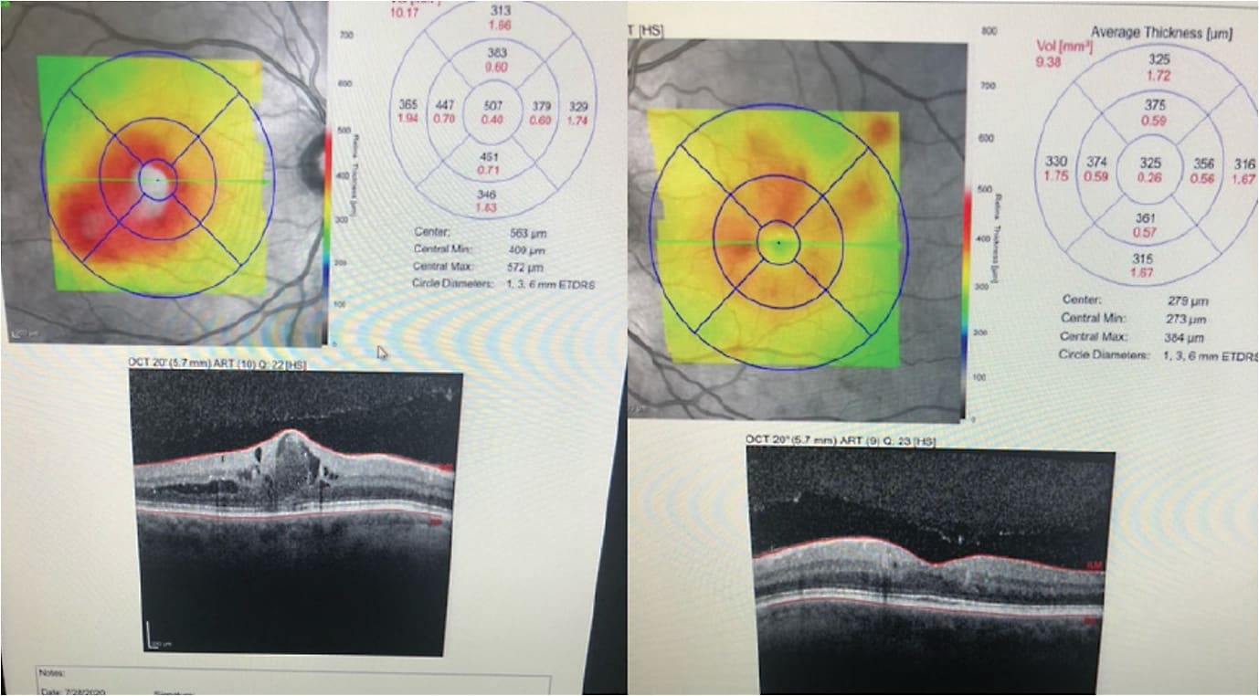 Figure 1: The patient presented with 20/50 vision and DME in the right eye. The left eye saw 20/20 with minimal edema.