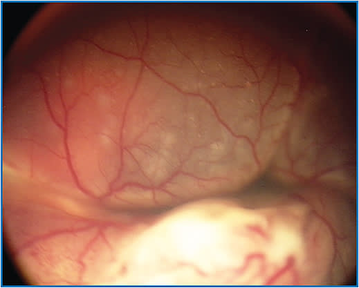 Figure 1. A Group D eye (at diagnosis) with retinoblastoma per the COG scheme.
Courtesy of David H. Abramson, MD