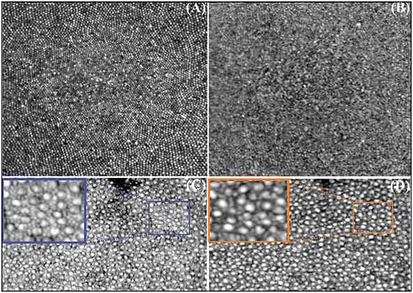 Figure 2. Average of 50 motion-corrected cone mosaics at the fovea from the adaptive optics (AO) scanning laser ophthalmoscopy (SLO) channel (A) and AO-optical coherence tomography (OCT) channel (B). Average of 50 motion-corrected cone mosaics at 6° temporal retina from the SLO channel (C) and OCT channel (D). Figure adapted with permission from The Optical Society.14