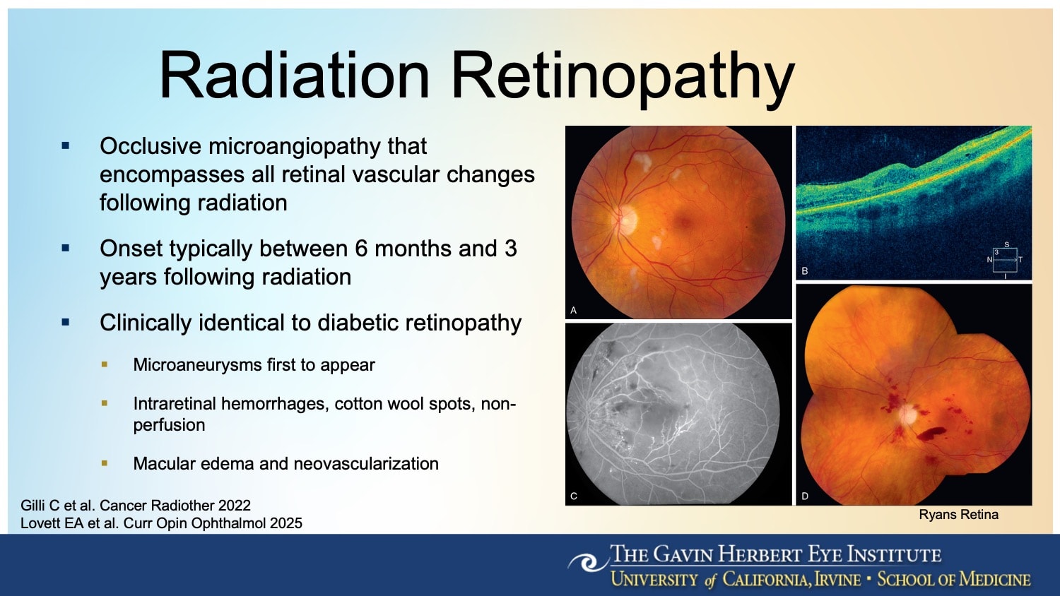 <p><strong>Figure 1.</strong> Radiation retinopathy presents with clinical features that are indistinguishable from diabetic retinopathy, including intraretinal hemorrhages, cotton wool spots, macular edema, and vascular nonperfusion.</p>