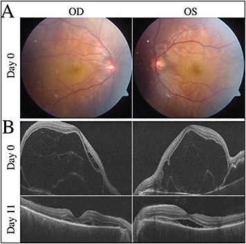 Figure 1. Serous retinal detachments. A 28-year-old Asian male presented with a 1-week history of bilateral vision decline and nonspecific symptoms of headaches, photophobia, and hearing loss (day 0). Fundus photos (Optos) revealed serous retinal detachments (RD) in both eyes (A). Optical coherence tomography (OCT) imaging (Cirrus; Zeiss) reveal significant exudative RD with hyperreflective stranding within the serous fluid (B, top). After 11 days of high-dose steroid therapy, the serous RDs improved dramatically with residual subretinal fluid still present (B, bottom). OD = right eye; OS = left eye.