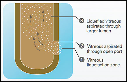 Figure 3. Vitesse hypersonic vitrectomy.
IMAGE COURTESY BAUSCH + LOMB.