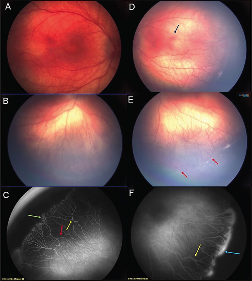 Figure 2. A 6-month-old African American male born prematurely at 24 weeks with high oxygen demand, diagnosed with retinopathy of prematurity. Contact fundus photography of the right eye reveals vascular tortuosity in the peripheral retina (A, B). Fluorescein angiogram of the right eye demonstrates branching of the terminal vessels (yellow arrow), circumferential vessels (red arrow) and lacey, feathery capillary bed in the periphery (green arrow) (C). Contact fundus photography of the left eye reveals vessels encroaching into the macula (dark blue arrow) and circumferential vessels in the periphery (red arrow) (D, E). Fluorescein angiogram of the right eye demonstrates branching of the terminal vessels (yellow arrow) and a classic homogenous leakage pattern present at the ridge (light blue arrow) (F).