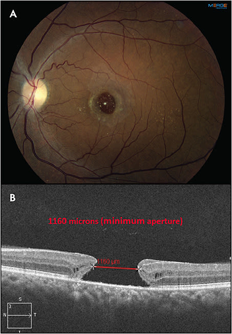 Figure 1. Fundus photo (A) and OCT (B) at preoperative visit of a 64-year-old male presenting with a large macular hole.