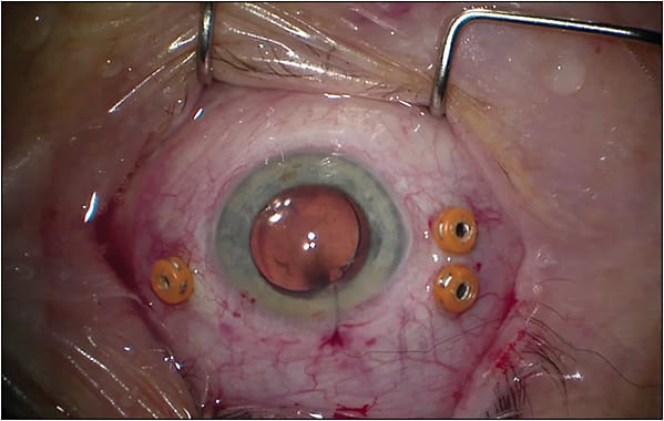 Figure 2. A suture is placed in the anterior segment to ensure fluidic stability.