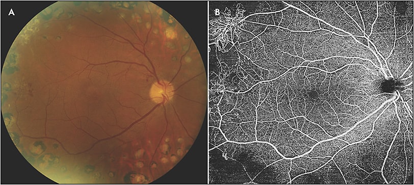 Figure 2. Fundus photos displaying quiescent proliferative diabetic retinopathy with peripheral laser (A). swept-source optical coherence tomography angiography (Plex Elite 9000; Carl Zeiss Meditec) superficial retina slab of 12 mm x 12 mm scans showing peripheral neovascularization (B).