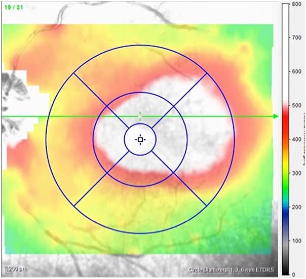 Figure 1. Pretreatment OCT imaging of a 62-year-old female with CRVO and chronic macular edema in her left eye with vision of 20/100.