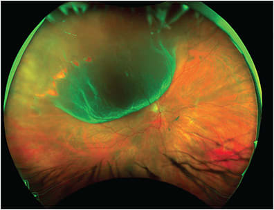 Figure 1. A 63-year-old female with high myopia presented with vision loss in the right eye and was found to have a macula-off rhegmatogenous retinal detachment from 9 o’clock to 12:30 with near contiguous breaks along a posterior vitreous base insertion from 9 o’clock to 11 o’clock. The patient underwent pars plana vitrectomy, fluid-air exchange, endolaser surrounding all noted breaks, .