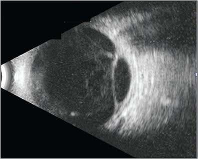 Figure 5. B scan of traction retinal detachment, left eye.