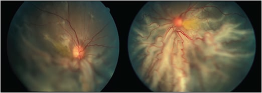 Figure 2. Progression of retinal detachment in patient 4, resulting in massive diffuse subretinal fibrosis in both eyes.