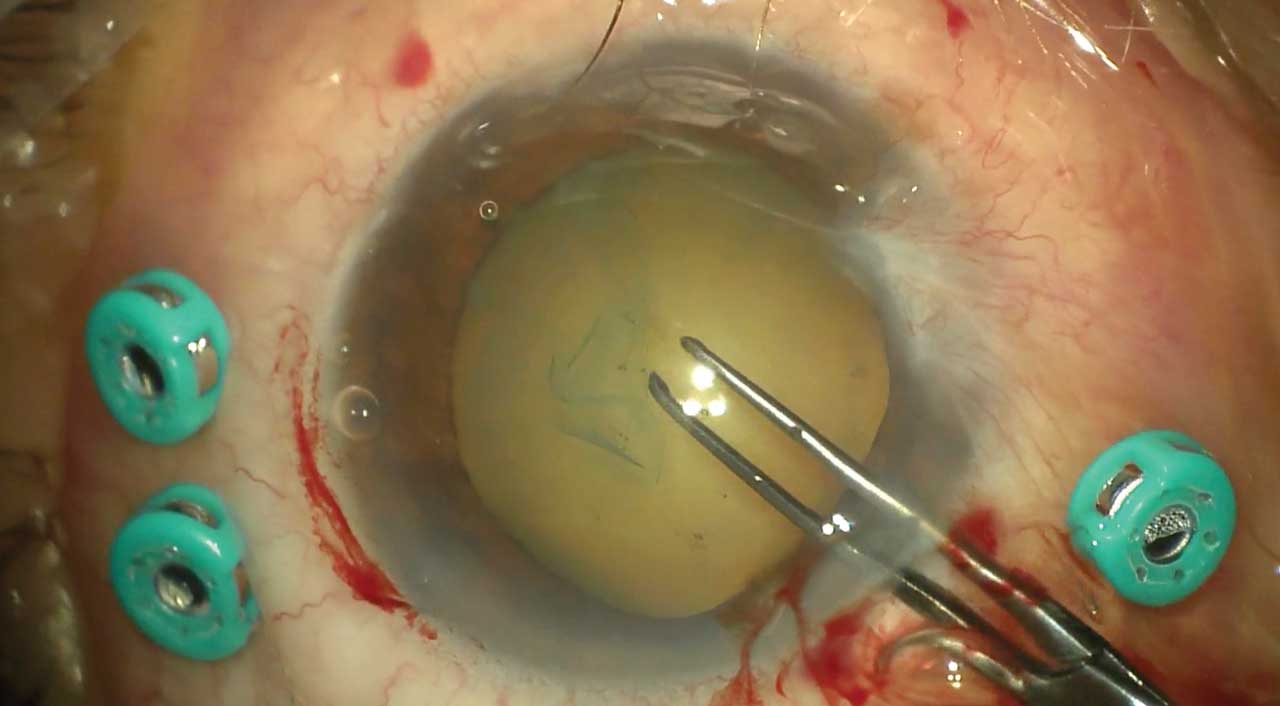 Figure 1. Trocar placement prior to anterior-segment incisions helps ensure easy access to the posterior segment at any time during phacovitrectomy.