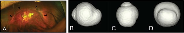 Figure 8. Wide, macular staphyloma (modified from reference #4). A. In widefield fundus image, the upper edge of wide staphyloma is observed as pigmentary abnormalities (arrowheads). B through D. 3D MRI images show posterior outpouching of wide area of posterior segment of the eye in the image viewed from inferior (B), nasal (C), and back (D) views.