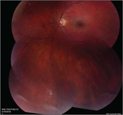 Figure 1. Vitreous snowballs, left eye.