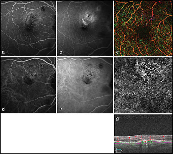 Figure 2. Fluorescein angiography, ICG, and OCTA (Zeiss Angioplex) in an individual with a known history of dry AMD. Both early (A) and late (B) FA show varying degrees of hyperfluorescence, raising some concern for development of a neovascular membrane. Depth-encoded OCTA of the retinal vasculature (6 mm x 6 mm) without obvious abnormal vascular structures (C). Both early and late ICG show mild hyperfluorescence and perhaps some mild leakage corresponding to area of hyperfluorescence seen on FA (D, E). En-face OCTA of the choriocapillaris and outer retina (due to irregular automated segmentation) shows a neovascular membrane present within the pigment epithelial detachment (PED) seen within the B-scan (G) (green areas denote flow within the PED).