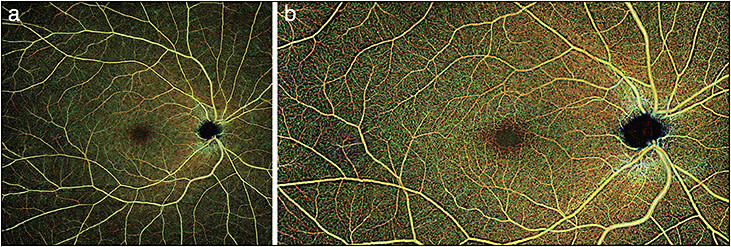 Figure 4. Both A and B represent widefield montages in a normal patient reconstructed by the currently research-only swept-source-based Zeiss Plex Elite 9000 OCTA platform, and demonstrate the potential wide-angle imaging capabilities of OCTA.