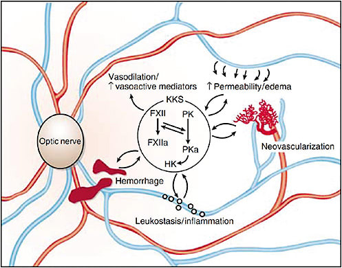 Figure 2. Potential interactions of the KKS in diabetic retinopathy. Schematic of the retinal fundus illustrating the potential involvement of the components of the KKS found in the vitreous in diabetic retinopathy changes. Red lines indicate arteries and blue lines indicate veins. FXII, factor XII; FXIIa, factor XIIa; HK, high-molecular-weight kininogen; PKa, plasma kallikrein; PK, prekallikrein; KKS, kallikrein–kinin system. Adapted from Phipps and Feener7 with permission.