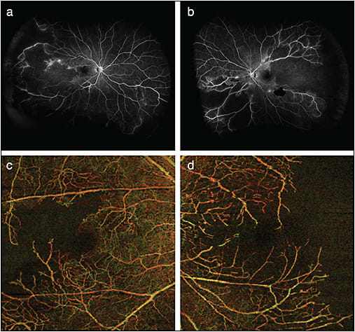 Figure 3. Widefield FA and OCTA (6 mm x 6 mm) (Zeiss Angioplex) in a young woman with a diagnosis of  lupus-associated retinal vasculitis. Widefield FA of the right (A) and left (B) eyes demonstrates marked retinal nonperfusion, as well as some areas of vascular leakage and/or staining. Depth-encoded  OCTA of both retinas clearly shows the extent of macular ischemia in both eyes but also demonstrates the limited field-of-view in comparison to widefield FA (C, D).