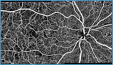 AngioVueHD (Optovue) Montage automatically combines two high-density images in a 10x6 mm field-of-view.
Image courtesy of Adil El Maftouhi, OD, Lyon, France
