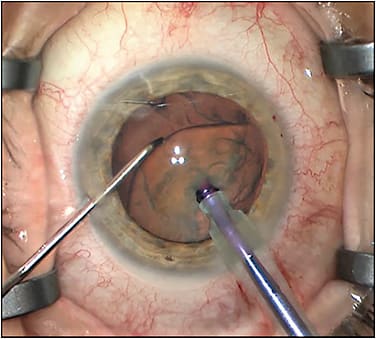 Figure 3. A patient with cataract and epiretinal membrane. Techniques such as nuclear chopping lessen the amount of phacoemulsification energy to which the endothelium is subjected. This decrease helps to optimize the view for the retina portion of the surgery.