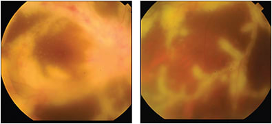 Figure 1. Fundus photographs of the right eye of a 38-year-old female HIV patient with cytomegalovirus retinitis and extensive “frosted branch angiitis” with a CD4 count of 50 cells/uL.