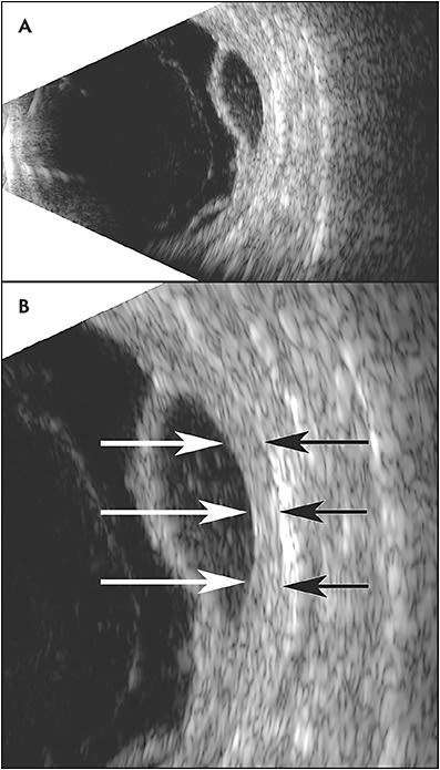 Figure 3. B-scan imaging shows multiple dome-shaped lesions with subretinal opacities (A). Note the normal underlying choroid (B, arrows).