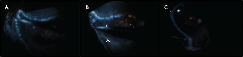 Figure 2. In this patient with Stickler syndrome and associated high myopia, multiple recurrent retinal detachments with subsequent proliferative vitreoretinopathy and breaks along the edge of prior endolaser necessitated a 270° retinectomy. Intraoperative imaging shows the row of diathermy, the retinectomy location along the anterior third of the diathermized spots, and the adherent retina in an area of prior endolaser (A). Perfluorocarbon liquid was used to support the retina posteriorly (B; white arrowhead). A fluid-air exchange was performed, and confluent endolaser was applied (C). There is an oblique angle of the retinectomy toward the ora serrata. The retina anterior to the retinectomy noted in image A was removed. Images courtesy of Cynthia Toth, MD.