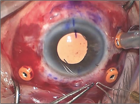 Figure 6. Well-centered IOL is shown as the superior haptic bulb is formed. The haptics can be slightly shortened to make minor centration adjustments if necessary.