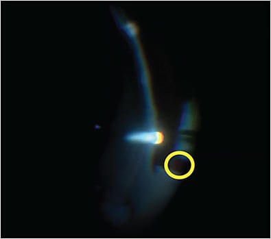 Figure 5. An iatrogenic choroidal hemorrhage (yellow circle) was caused by the vitrector when trying to lift and cut attached retina. The intraocular pressure was raised to 60 mmHg for one minute, and the bleeding stopped. Images courtesy of Cynthia Toth, MD.